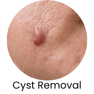 Cyst Removal