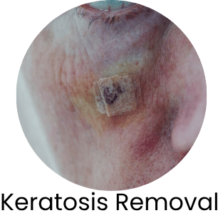 Keratosis Removal 