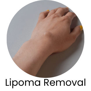 Lipoma Removal