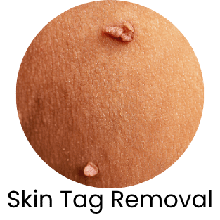 Skin Tag Removal