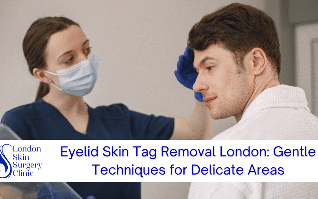 Eyelid Skin Tag Removal London: Gentle Techniques for Delicate Areas