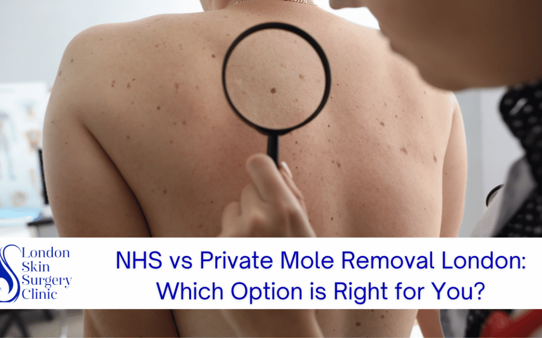 NHS vs Private Mole Removal London: Which Option is Right for You?