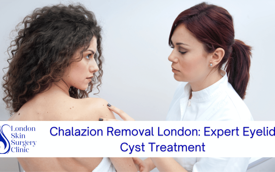 Chalazion Removal London: Expert Eyelid Cyst Treatment