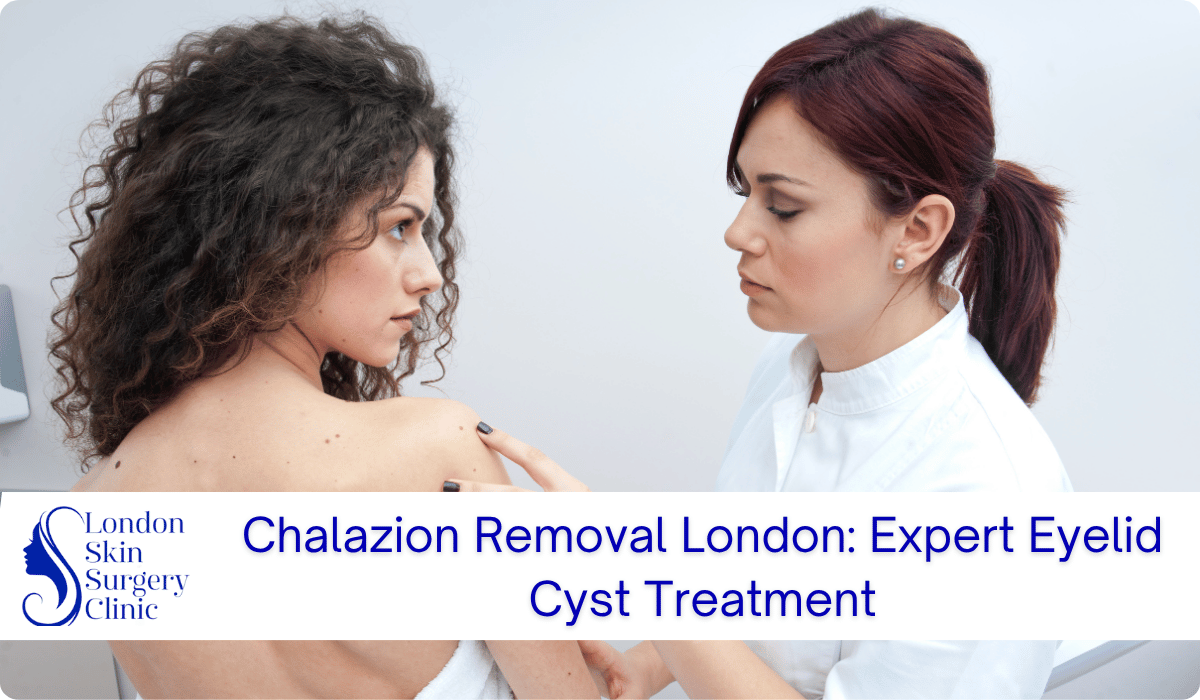 chalazion removal london eyelid cyst treatment chalazion removal london eyelid cyst treatment
