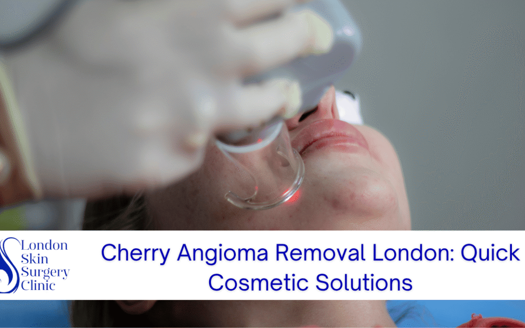 Cherry Angioma Removal London: Quick Cosmetic Solutions