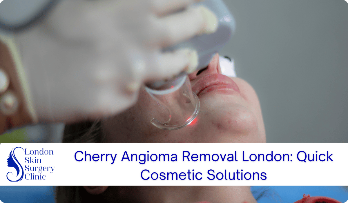 cherry angioma removal london quick cosmetic solutions