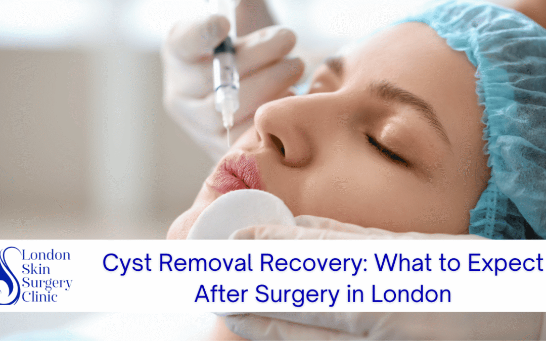 Cyst Removal Recovery: What to Expect After Surgery in London