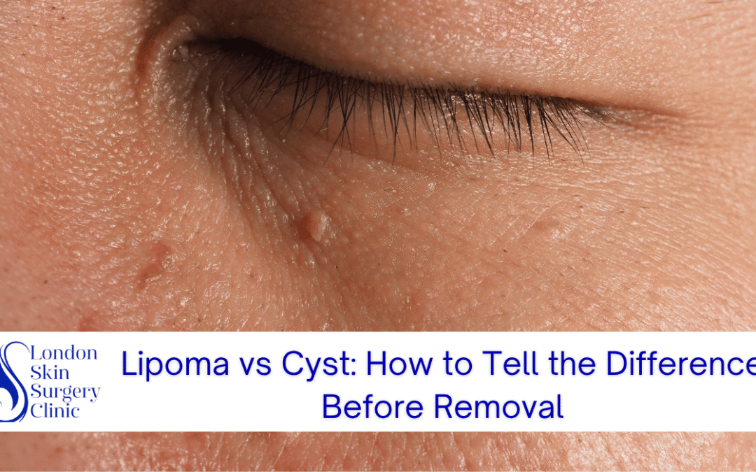 Lipoma vs Cyst: How to Tell the Difference Before Removal