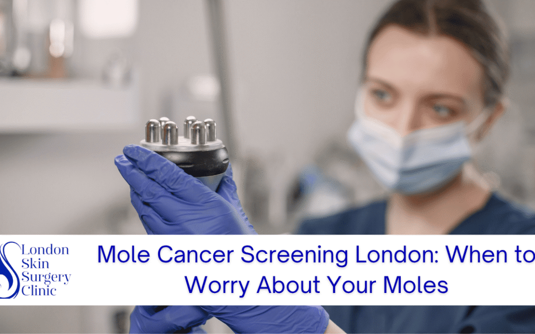 Mole Cancer Screening London: When to Worry About Your Moles
