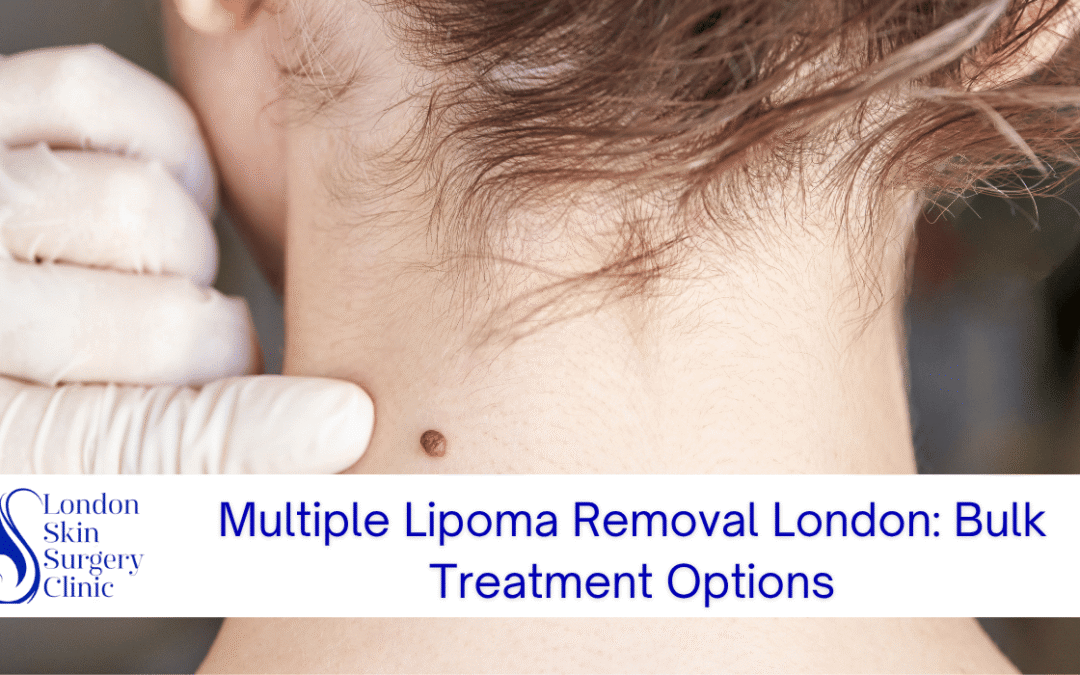 Multiple Lipoma Removal London: Bulk Treatment Options