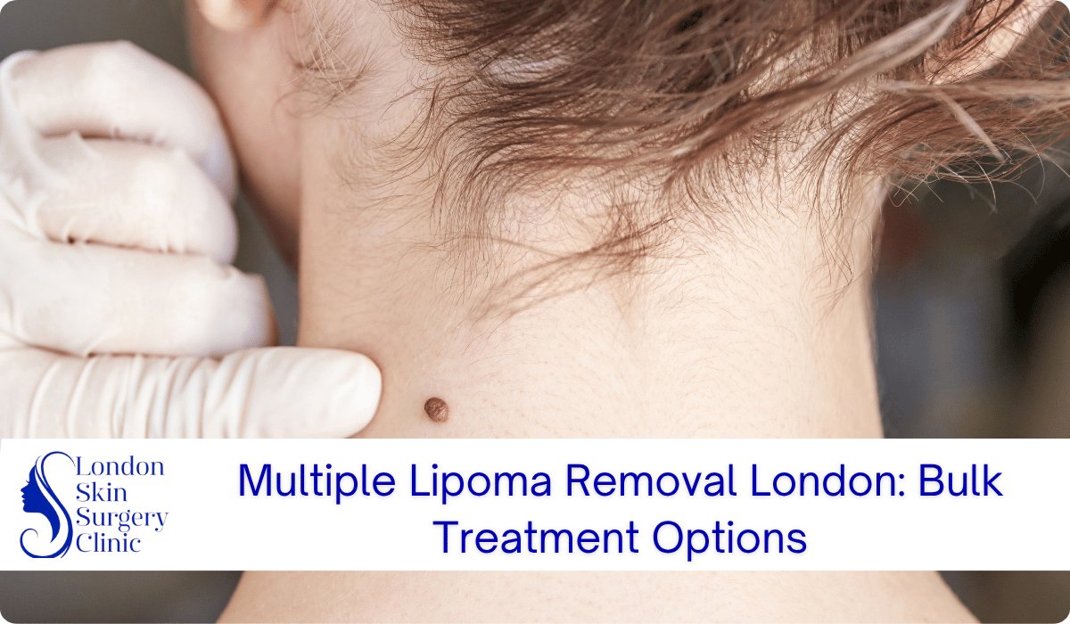 multiple lipoma removal london bulk treatment