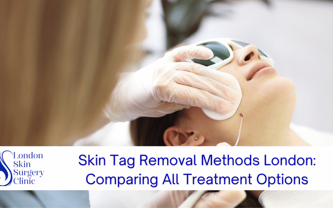 Skin Tag Removal Methods London: Comparing All Treatment Options