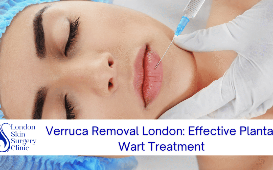 Verruca Removal London: Effective Plantar Wart Treatment