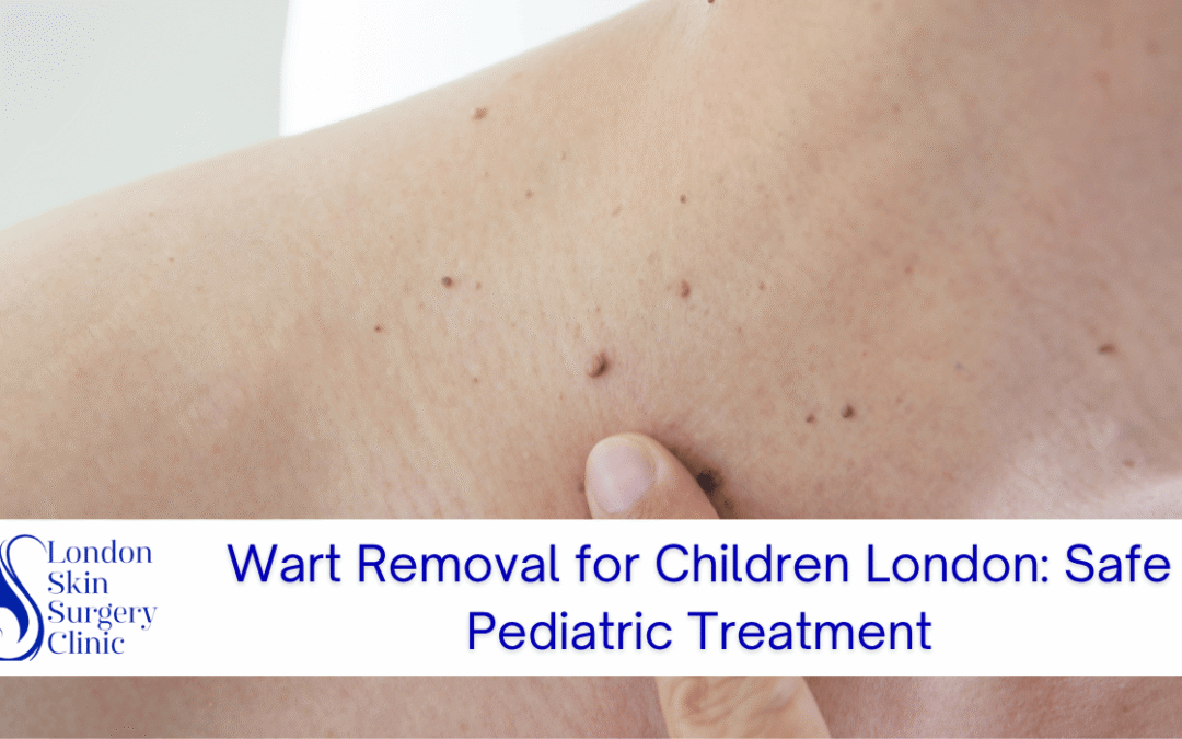 Wart Removal for Children London: Safe Pediatric Treatment