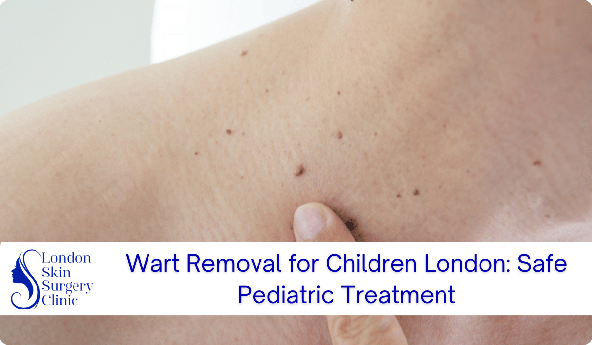 wart removal children london pediatric treatment