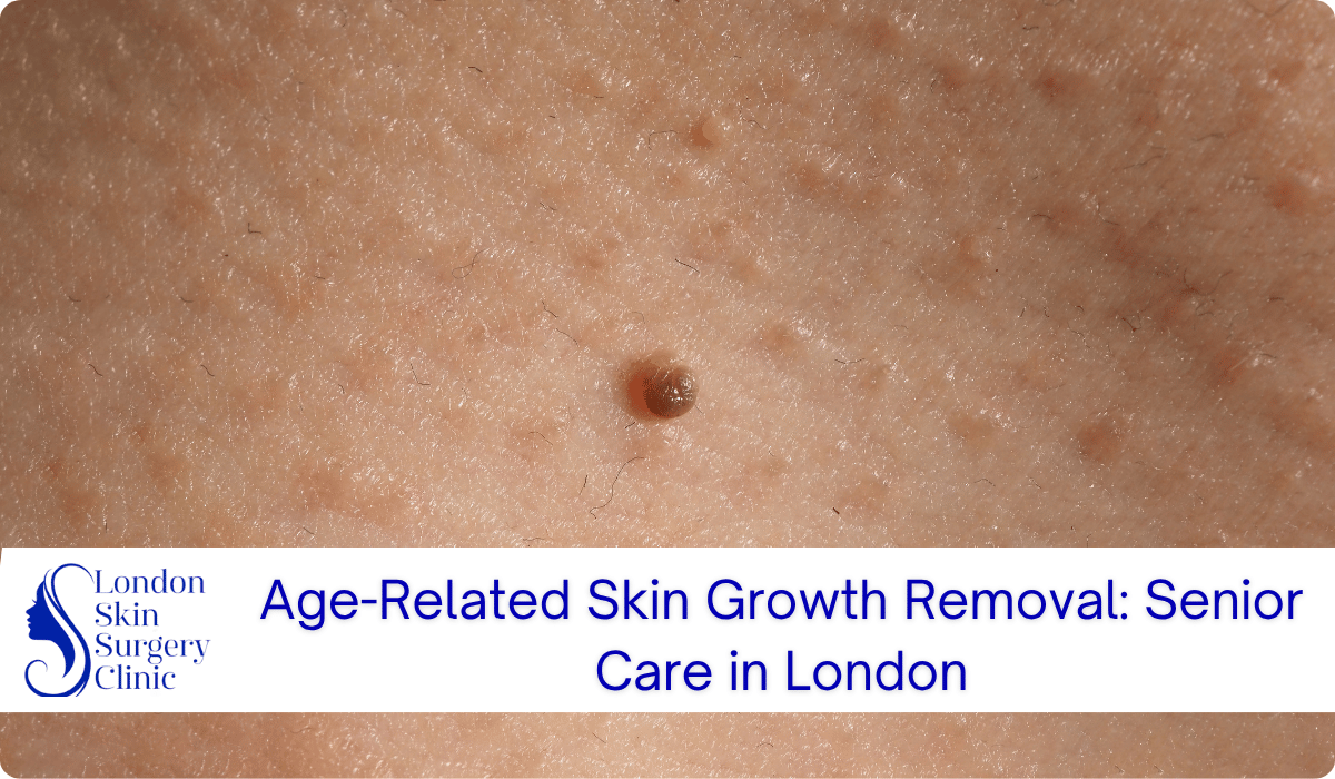 age related skin growth removal senior care age related skin growth removal senior care