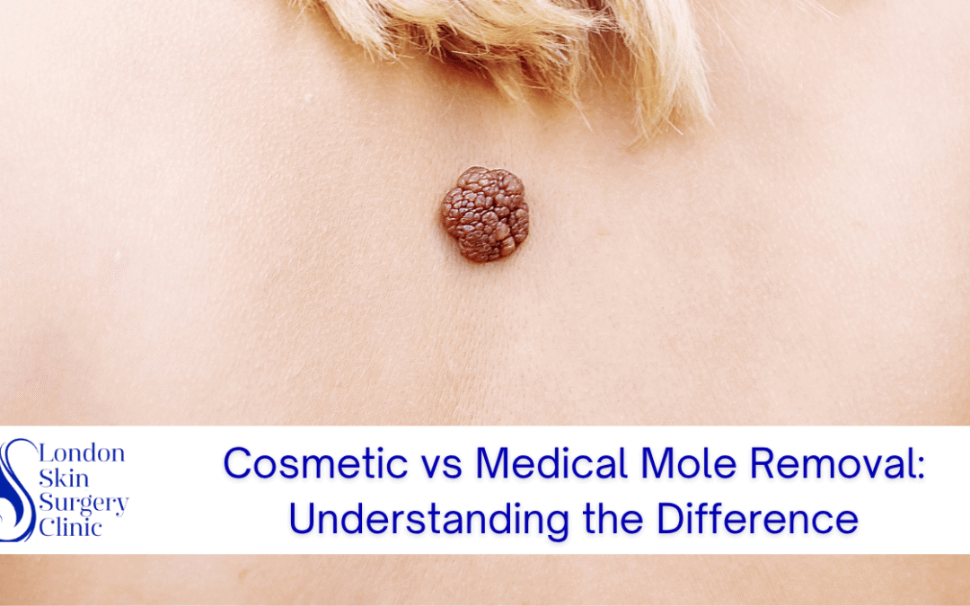 Cosmetic vs Medical Mole Removal: Understanding the Difference