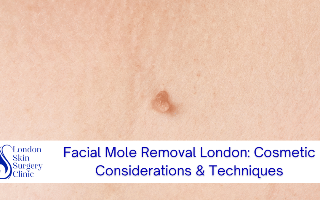 Facial Mole Removal London: Cosmetic Considerations & Techniques