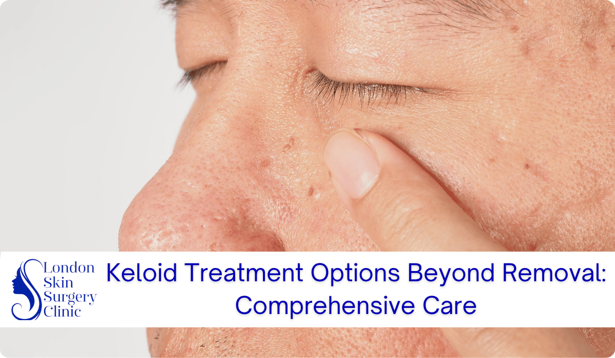 keloid treatment options comprehensive care london keloid treatment options comprehensive care london