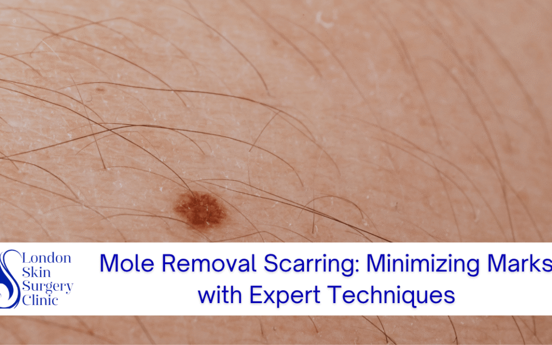 Mole Removal Scarring: Minimizing Marks with Expert Techniques