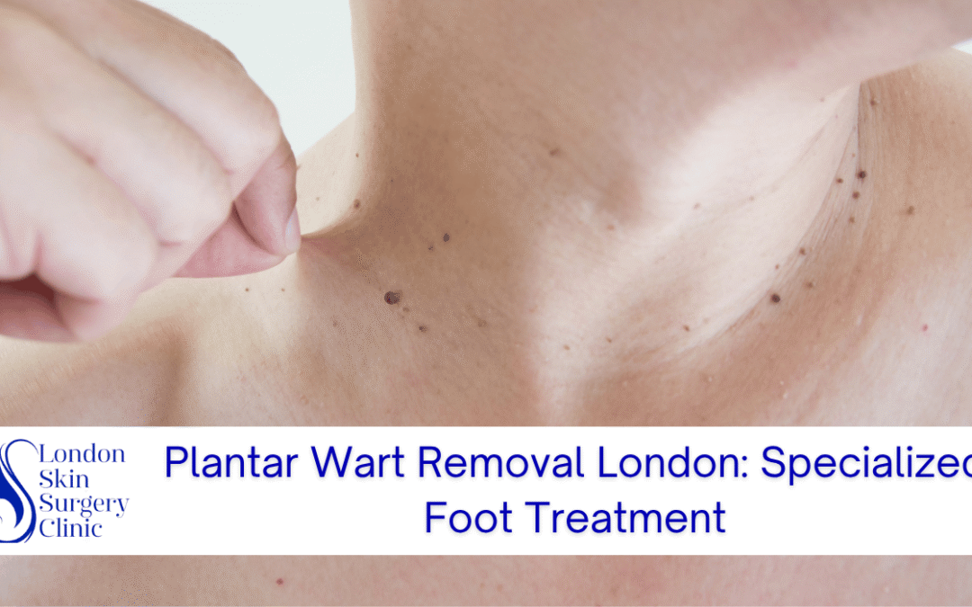 Plantar Wart Removal London: Specialized Foot Treatment