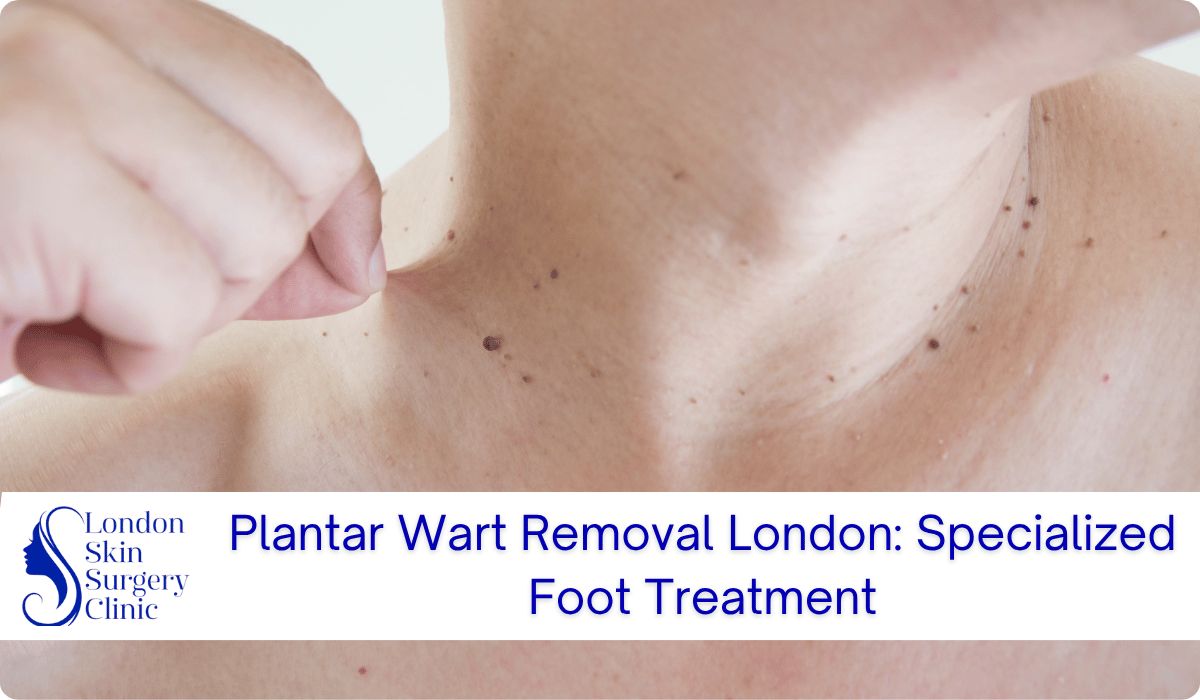 plantar wart removal london foot treatment