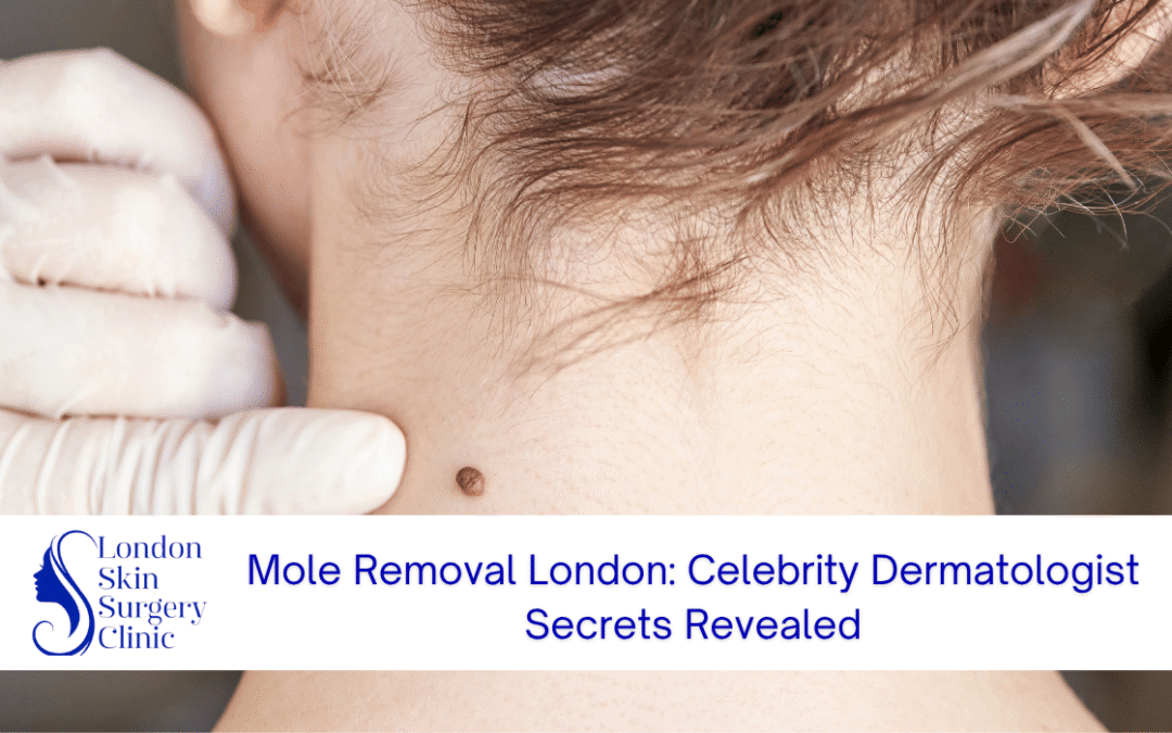 celebrity mole removal london dermatologist secrets