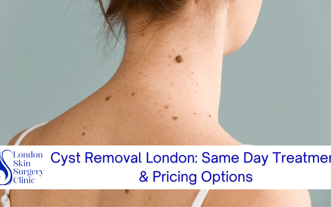 Cyst Removal London: Same Day Treatment & Pricing Options