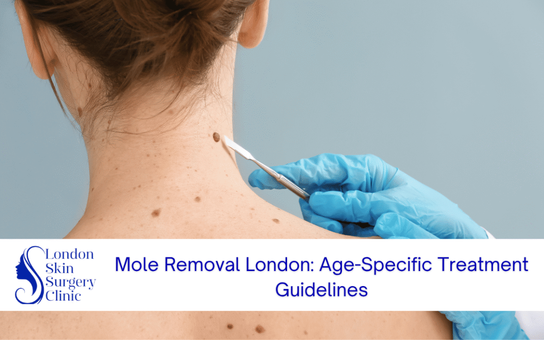 age specific mole removal london treatment guidelines