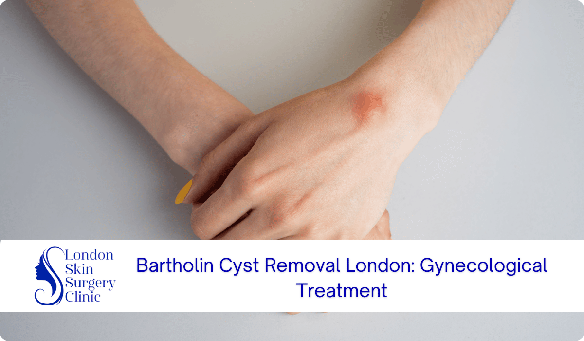 bartholin cyst removal london gynecological treatment bartholin cyst removal london gynecological treatment