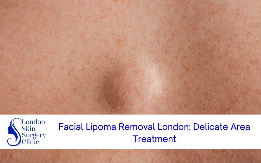 facial lipoma removal london delicate area treatment