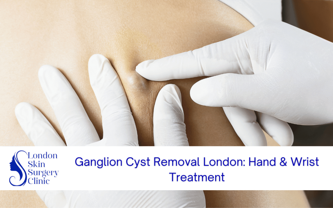 ganglion cyst removal london hand wrist treatment