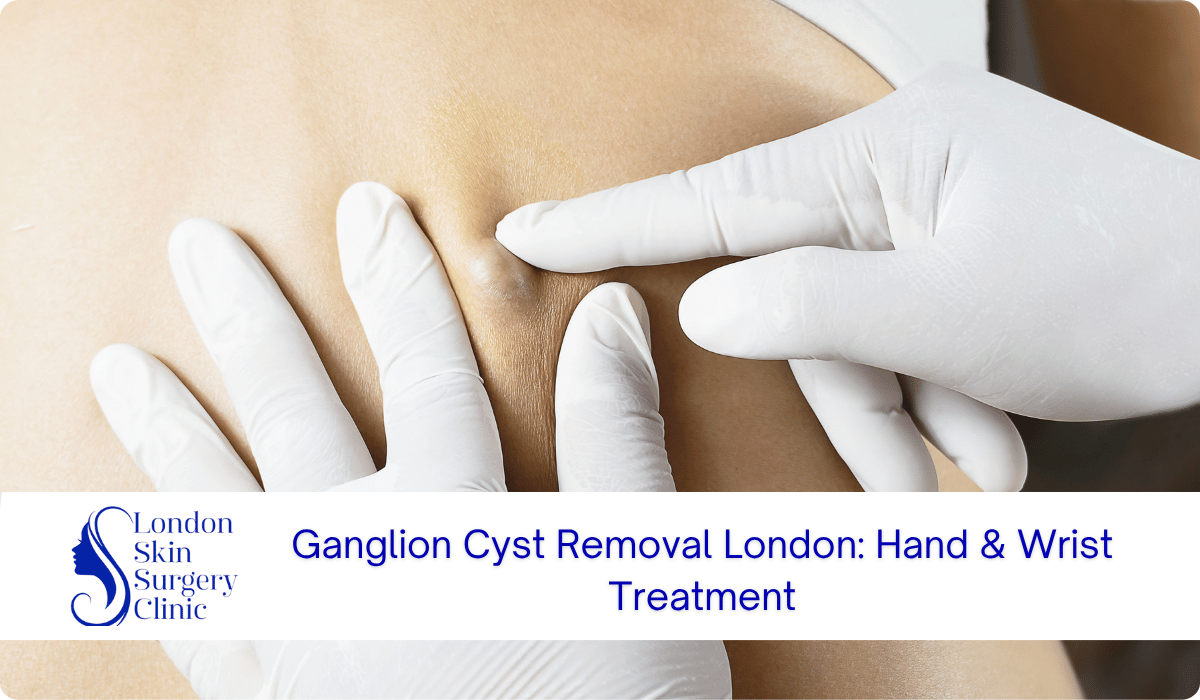 ganglion cyst removal london hand wrist treatment