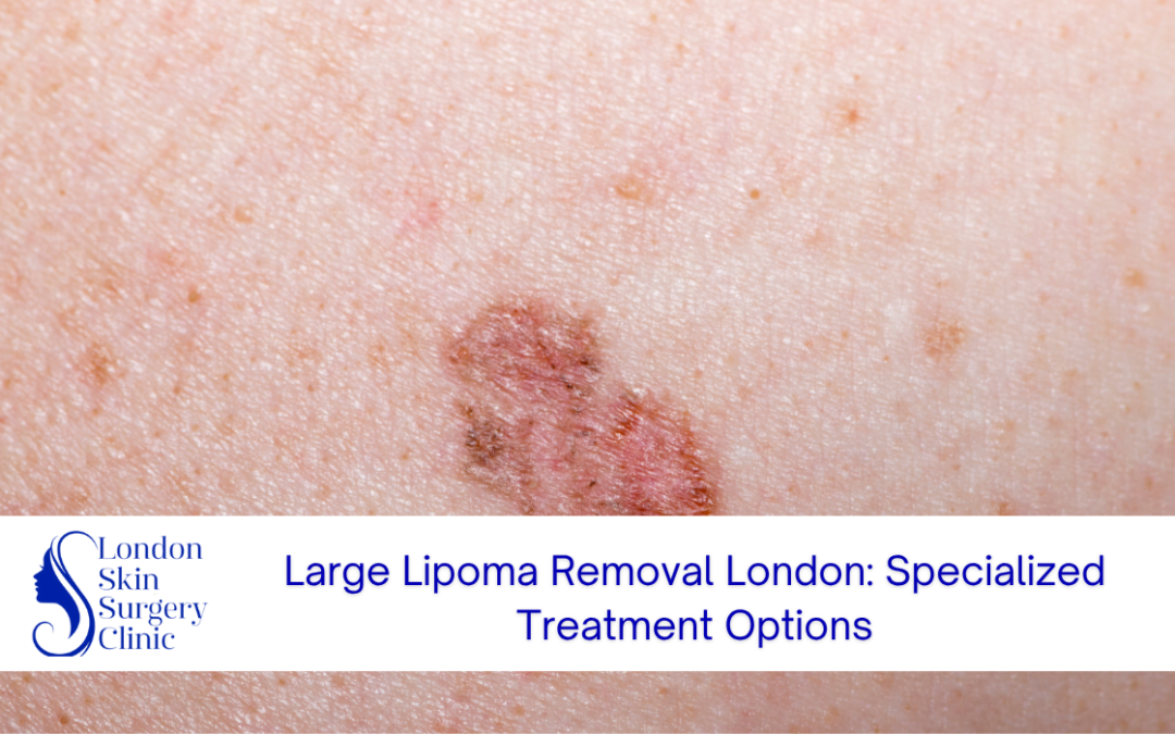Large Lipoma Removal London: Specialized Treatment Options