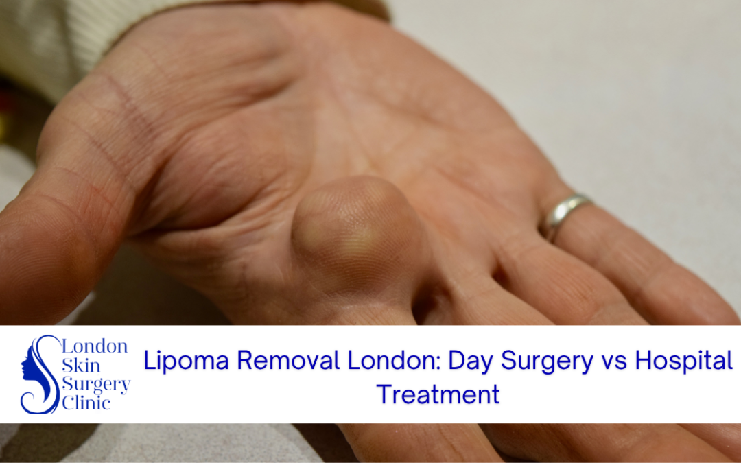 lipoma removal london day surgery hospital treatment
