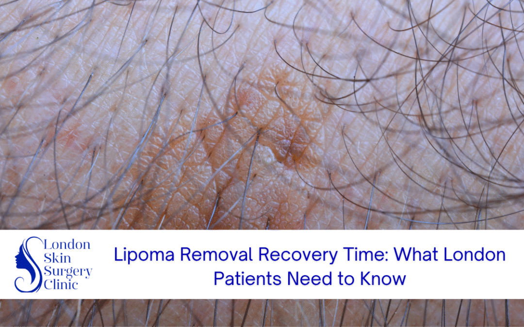 lipoma removal recovery time london patients guide