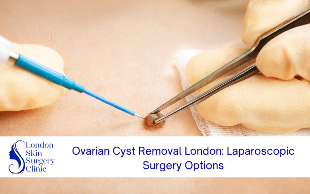 ovarian cyst removal london laparoscopic surgery
