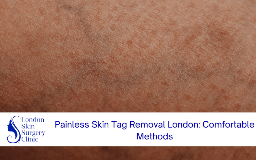 painless skin tag removal london comfortable methods