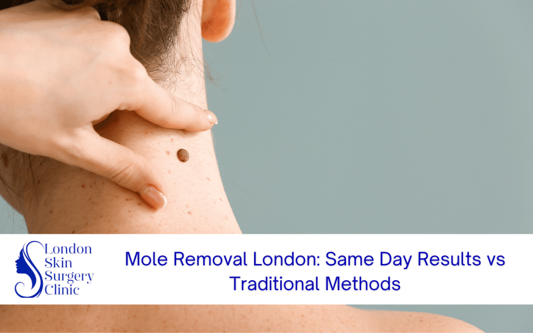 same day mole removal london traditional methods
