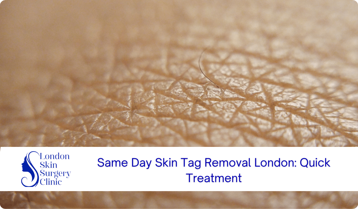 same day skin tag removal london quick treatment same day skin tag removal london quick treatment