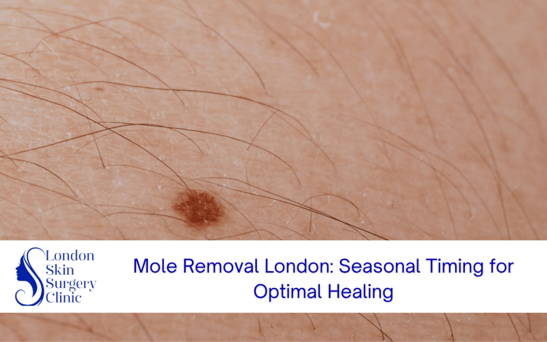 seasonal timing mole removal london optimal healing