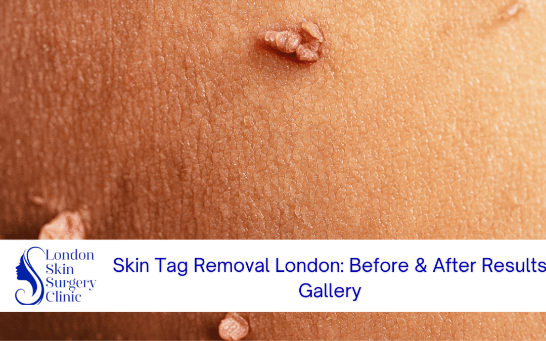 skin tag removal london before after results