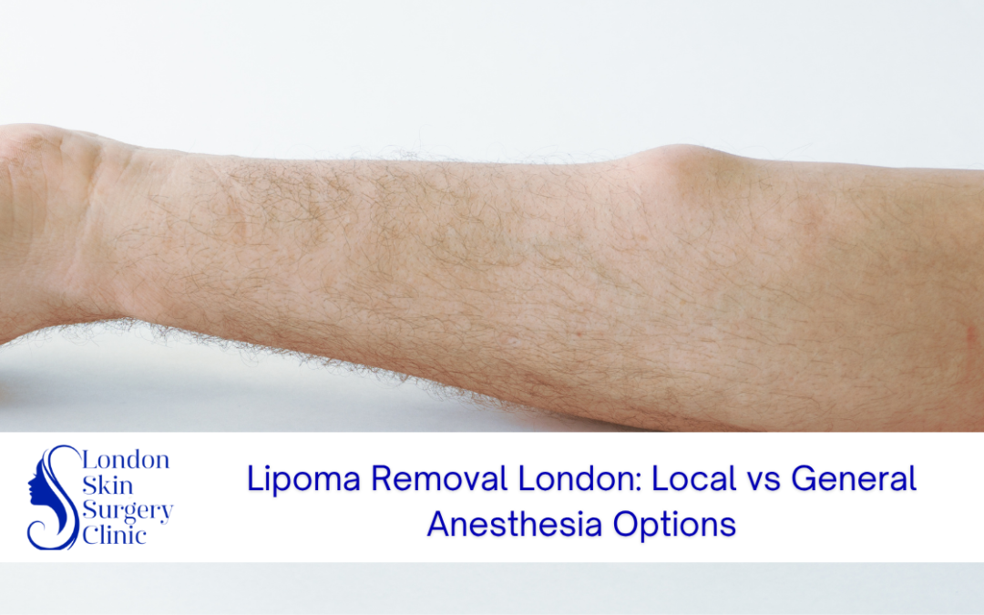 lipoma removal london local general anesthesia options