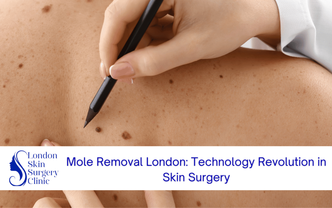 mole removal london technology revolution skin surgery