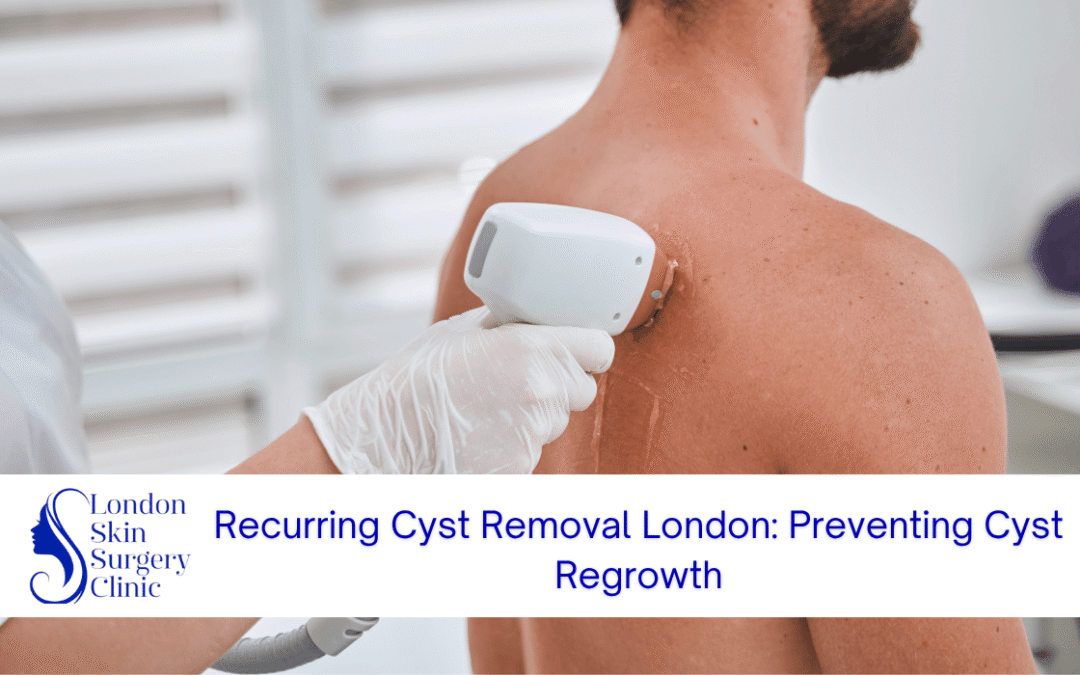 recurring cyst removal london preventing regrowth